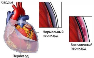 Острый перикардит