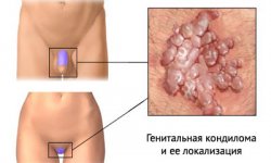 Кондиломы