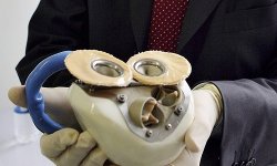 Во Франции умер третий пациент с искусственным сердцем