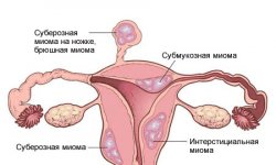 Миома