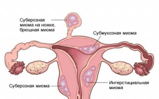 Миома