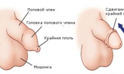 Парафимоз
