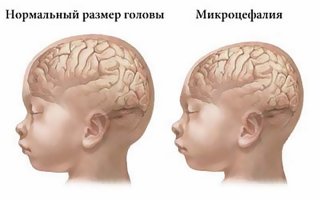 Микроцефалия