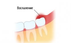 Перикоронит
