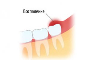 Перикоронит