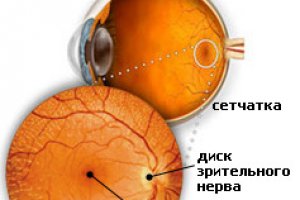 Макулит