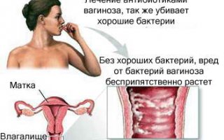 Гарднереллез