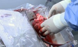 Пациент прожил 33 года после пересадки сердца