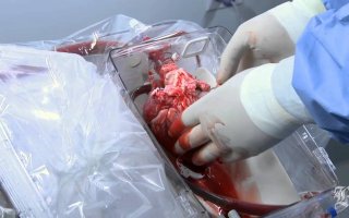 Пациент прожил 33 года после пересадки сердца