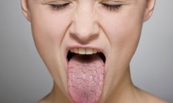 Складчатый (скротальный) язык