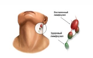 Напухшие лимфоузлы могут предупреждать об онкологических заболеваниях