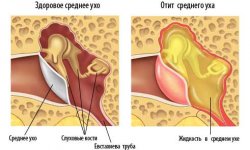 Отит