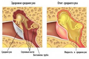 Отит