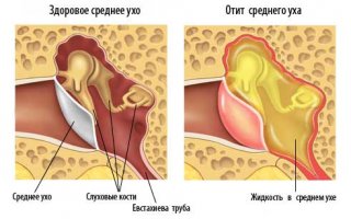Отит