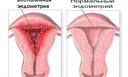Эндометрит