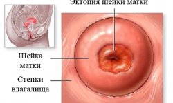 Эктопия шейки матки