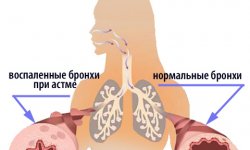Атопическая бронхиальная астма
