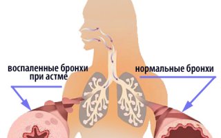 Атопическая бронхиальная астма