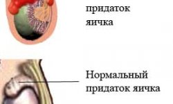 Эпидидимит