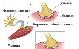 Миастения