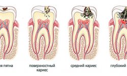 Кариес