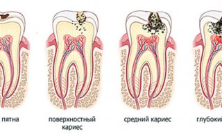 Кариес