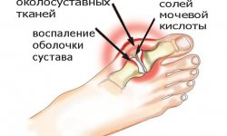 Подагра
