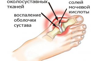 Подагра