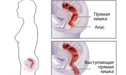 Выпадение прямой кишки