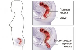 Выпадение прямой кишки
