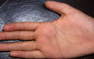 Синдром Фелти