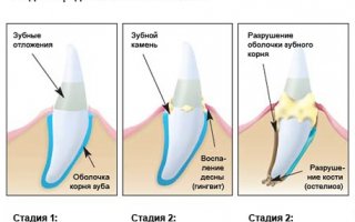 Пародонтоз