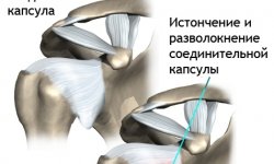Плечелопаточный периартроз