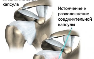 Плечелопаточный периартроз