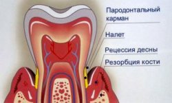 Пародонтит