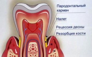 Пародонтит
