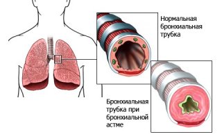 Бронхиальная астма