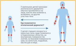 Атопический дерматит у детей
