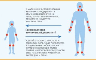 Атопический дерматит у детей
