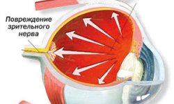 Глаукома
