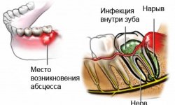 Периостит, абсцесс, флюс