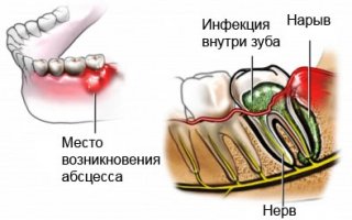 Периостит, абсцесс, флюс