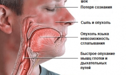 Анафилактический шок