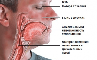 Анафилактический шок