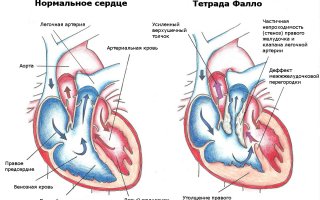 Тетрада Фалло