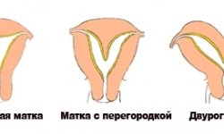 Двурогая матка