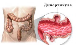Дивертикулярная болезнь