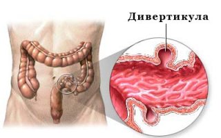 Дивертикулярная болезнь
