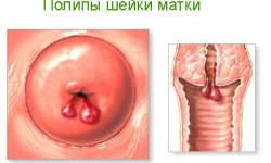 Полипы шейки матки