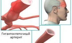 Гигантоклеточный (височный) артериит